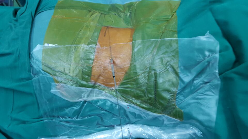 術(shù)中置入操作通道
